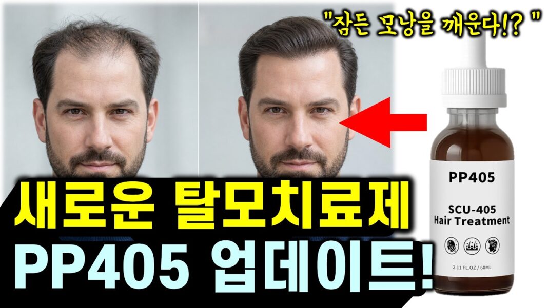 수술 없이 모발이식 효과를? 혁신적인 새로운 탈모약 PP405 임상시험 결과 분석