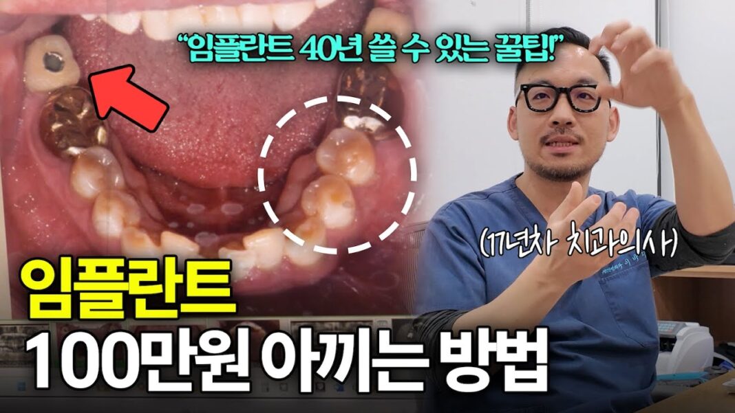 100만원 투자한 임플란트, 임플란트 평생 사용 꿀팁으로 후회 없이 관리하는 법